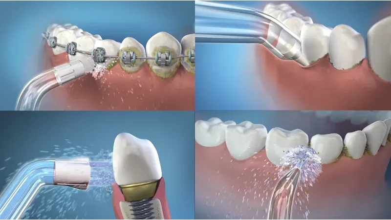 Máy tăm nước nha khoa - Giải pháp vệ sinh răng miệng hiện đại và tiện lợi